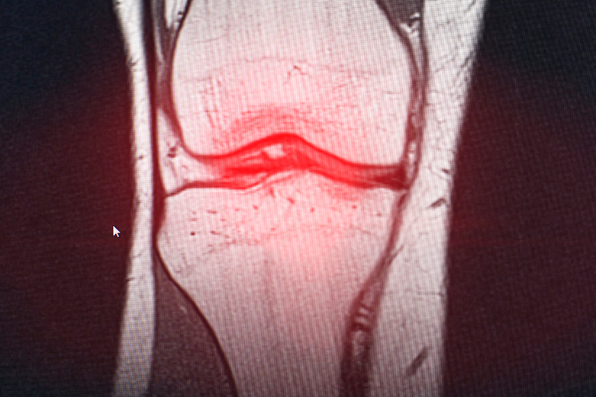 What is Bursitis and How Should You Treat It?